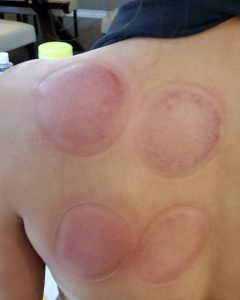 Cupping Marks